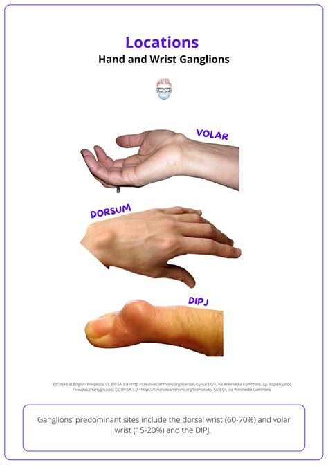 icd 10 code for right wrist ganglion cyst|ICD